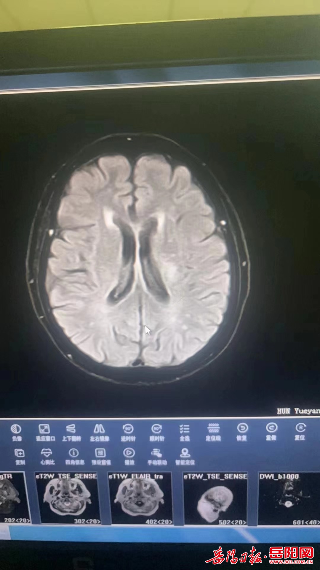 岳阳楼区人民医院开展急性缺血性脑卒中阿替普酶
