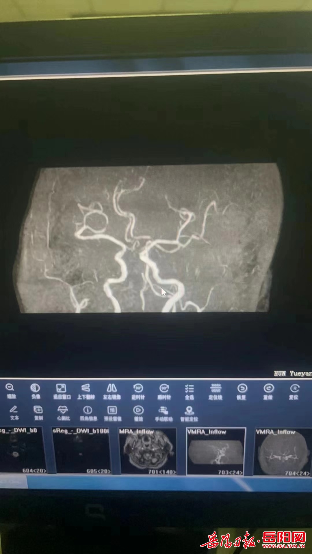 岳阳楼区人民医院开展急性缺血性脑卒中阿替普酶